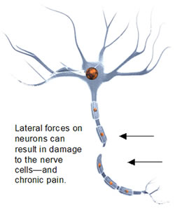 Nerve injury after auto injury